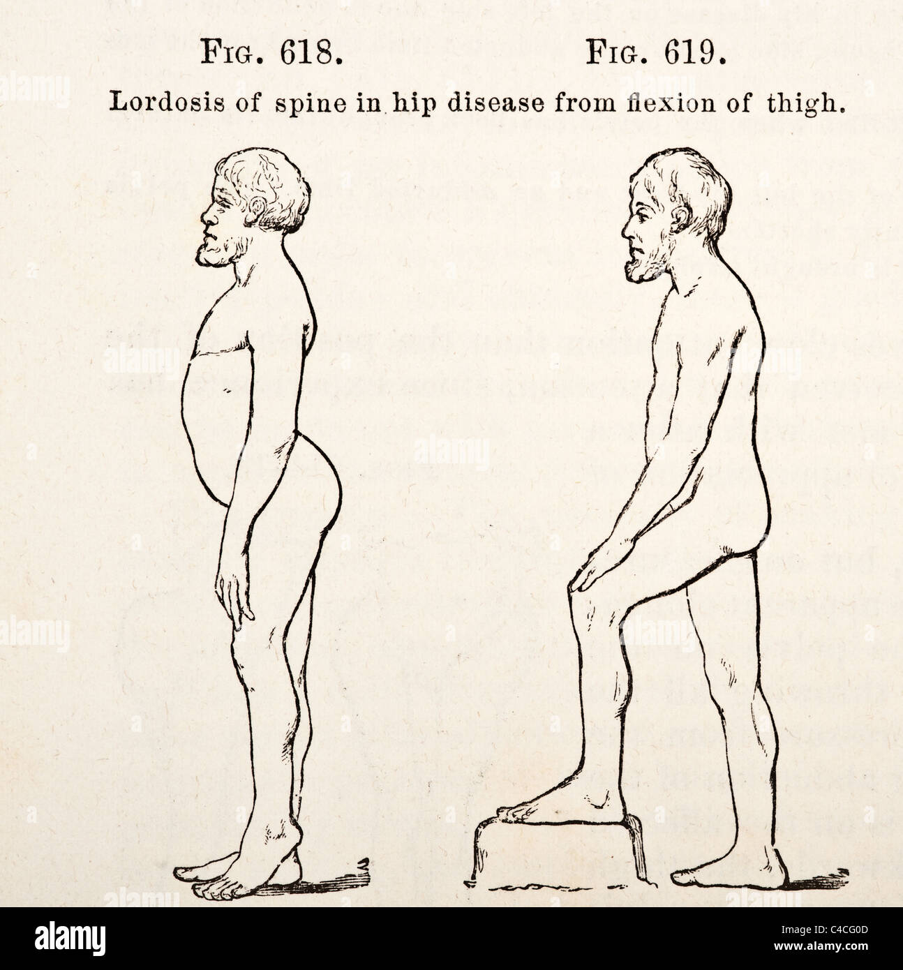 Illustration médicale antique d'Hip-Joint vers la maladie de la hanche 1881 Banque D'Images