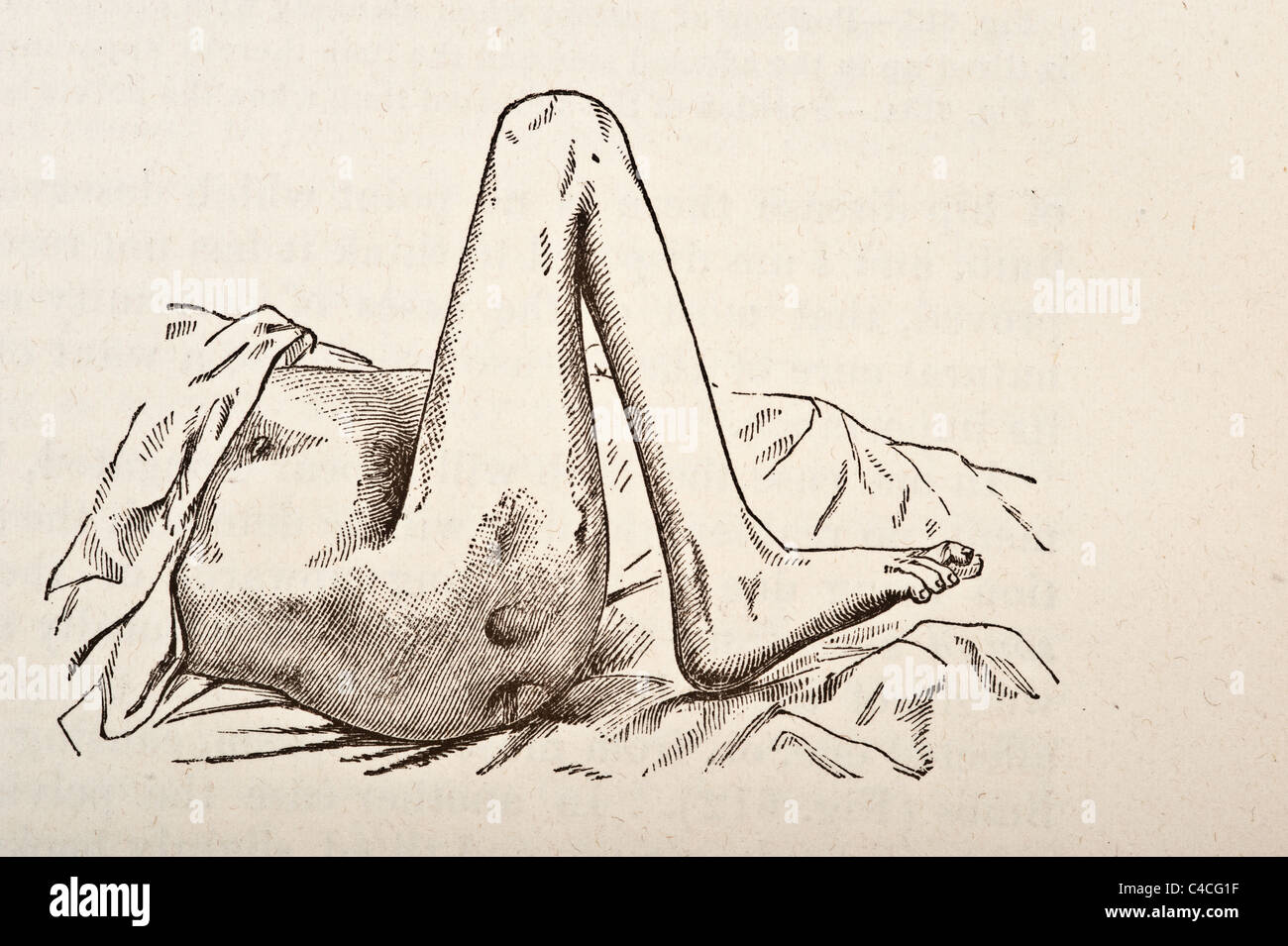 Illustration médicale antique d'Hip-Joint vers la maladie de la hanche 1881 Banque D'Images