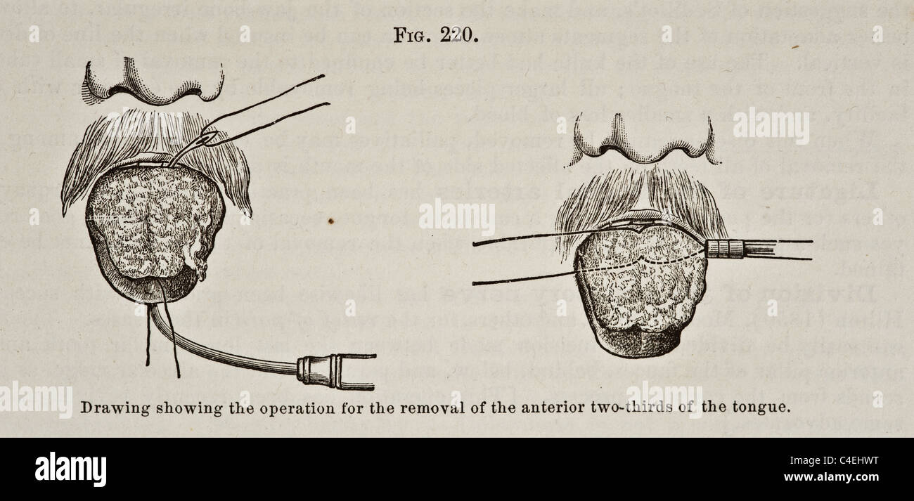 Illustration médicale antique langue dépose partielle vers 1881 Banque D'Images