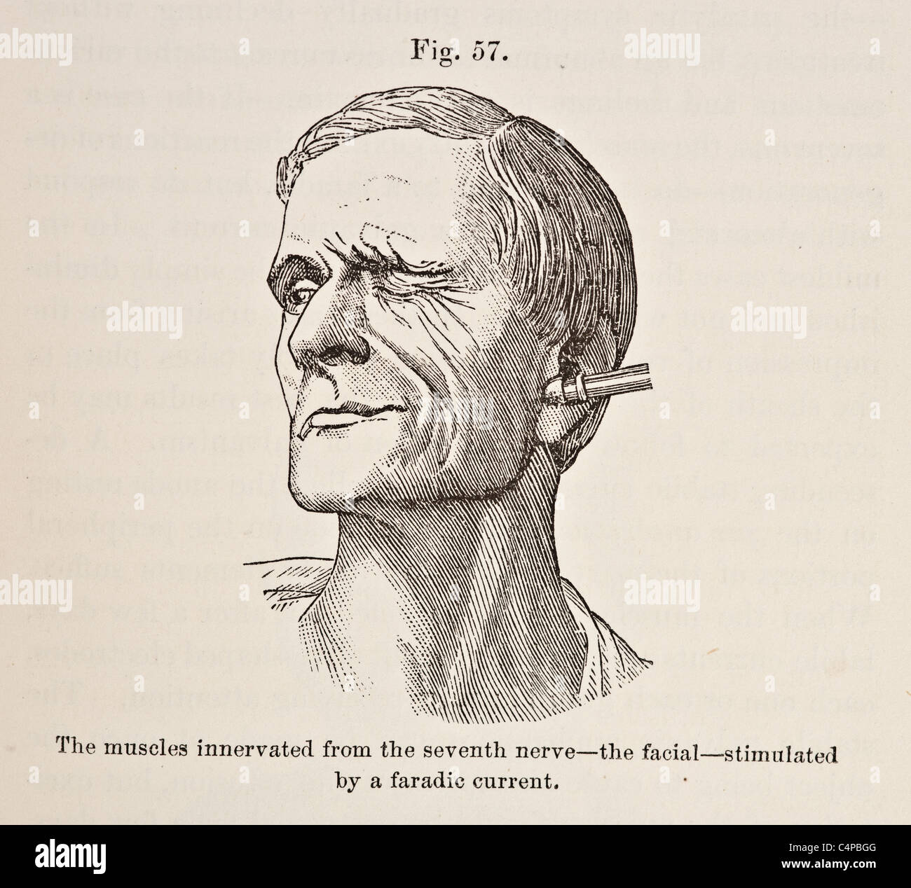 Illustration des muscles innervés de former le septième nerf-le faciale stimulés par l'Faradic Current vers 1881 Banque D'Images Illustration des muscles innervés de former le septième nerf-le faciale stimulés par l'Faradic Current vers 1881 Banque D'Images