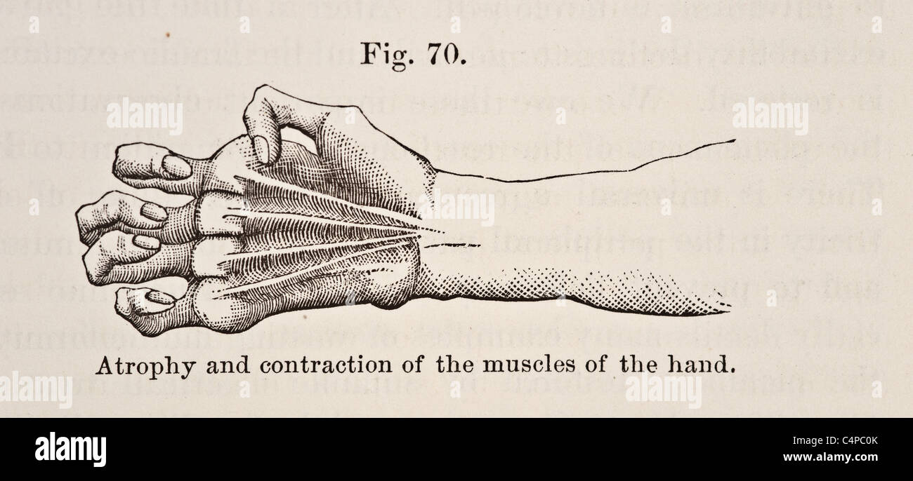 Illustration de l'atrophie et la contraction des muscles de la main vers 1881 Banque D'Images