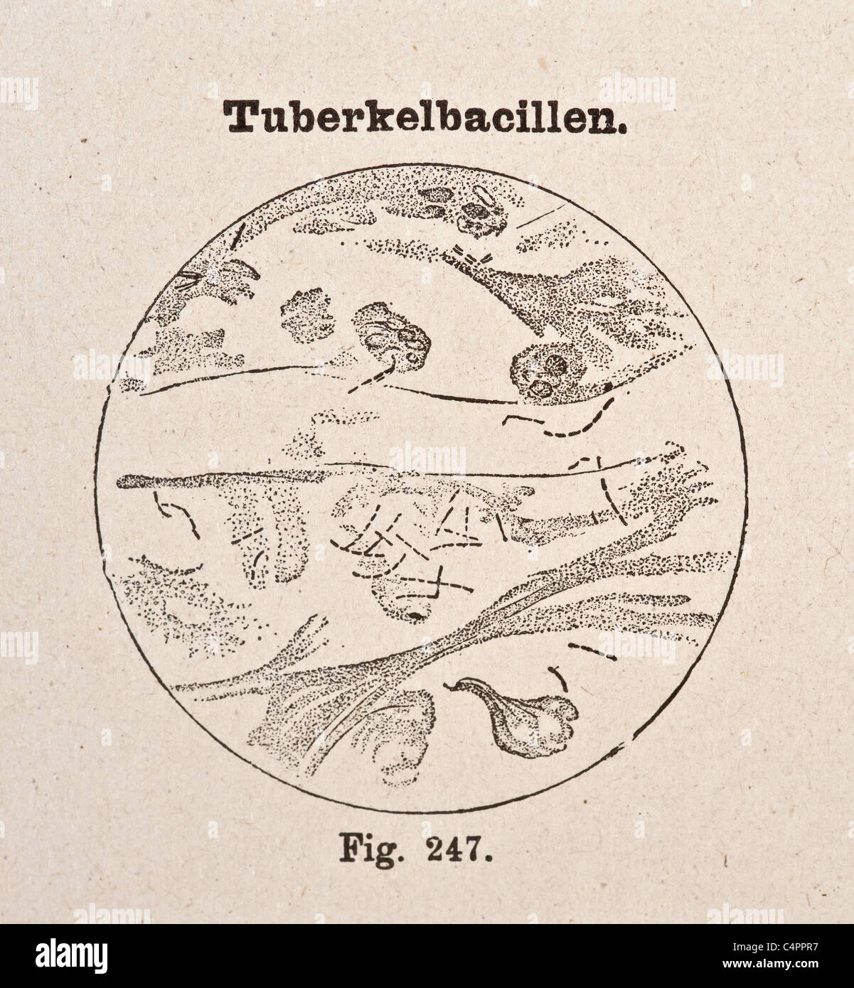 Illustration médicale antique vintage de bactérie de la tuberculose vers 1890 Banque D'Images
