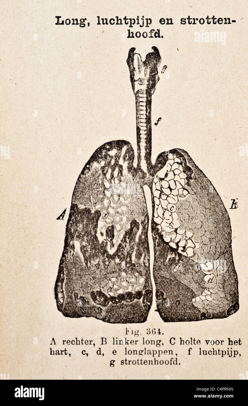 Une ancienne illustration noir et blanc de poumon malade Banque D'Images