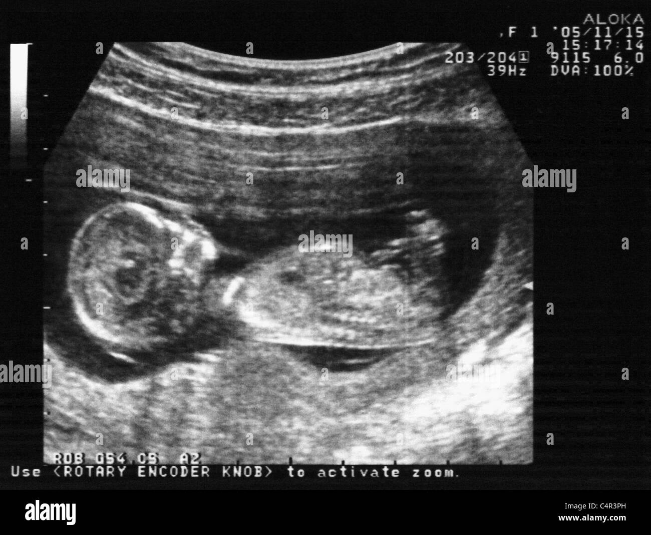 L Echographie D Un Fœtus De 3 Mois Photo Stock Alamy L Echographie D Un Fœtus De 3 Mois Photo Stock Alamy