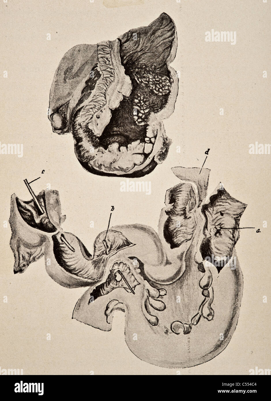 Anatomie des maladies y compris le cancer de l'intestin Banque D'Images
