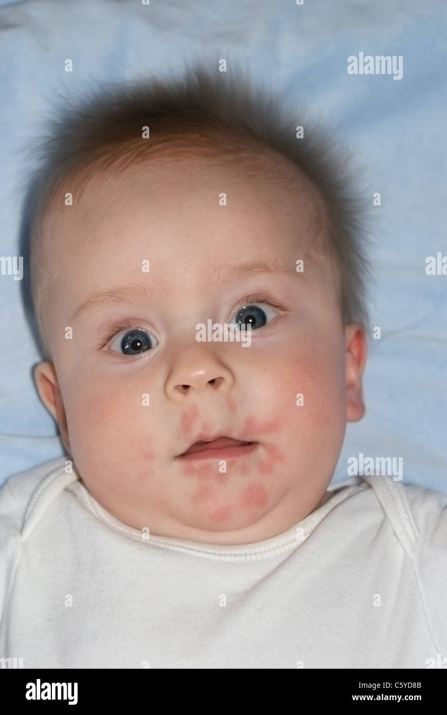 Baby with allergic Banque de photographies et d'images à haute ...