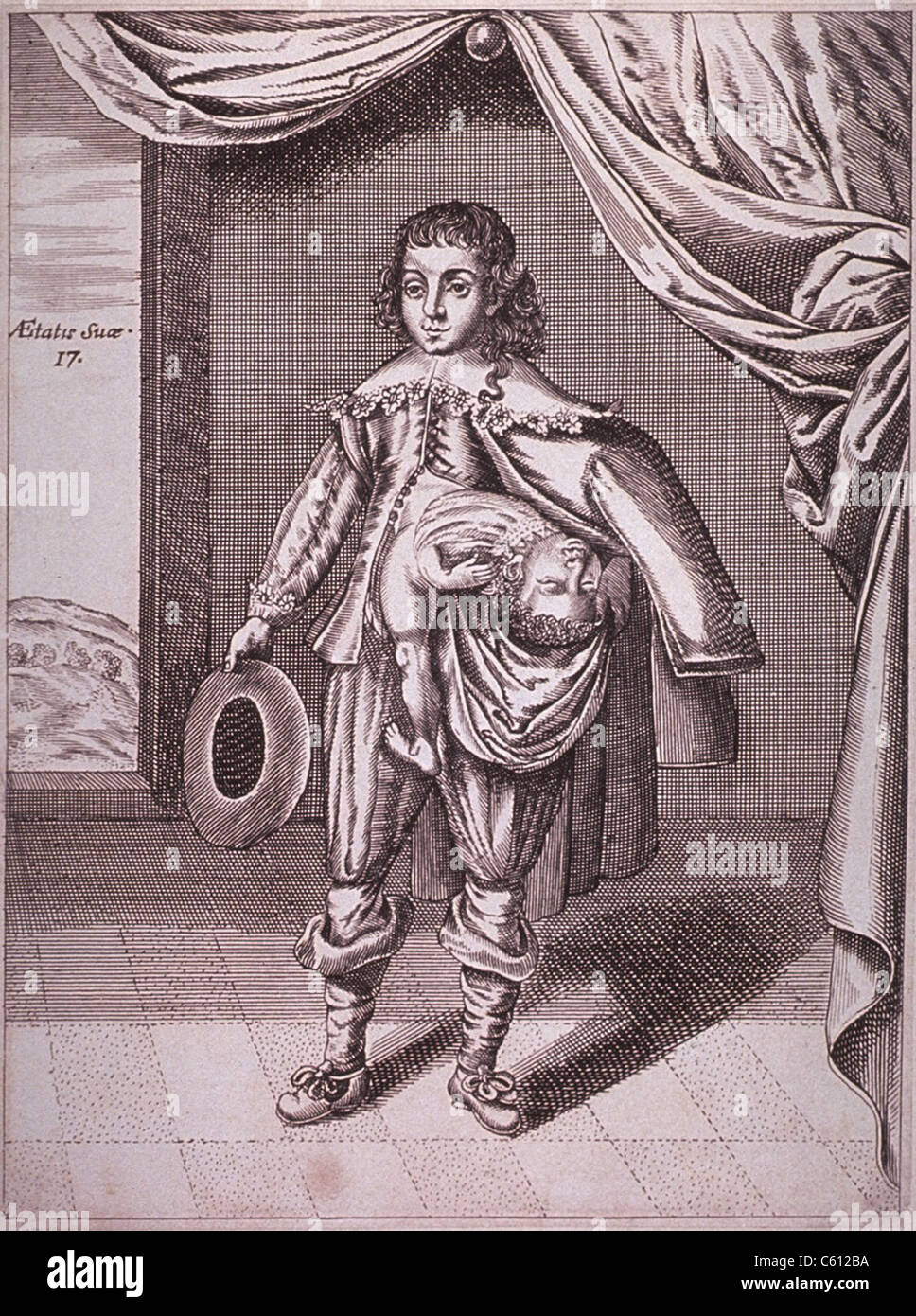 Garçon avec une déformation causée par une croissance double conjoined partielle de son côté. 1686 gravure. Banque D'Images