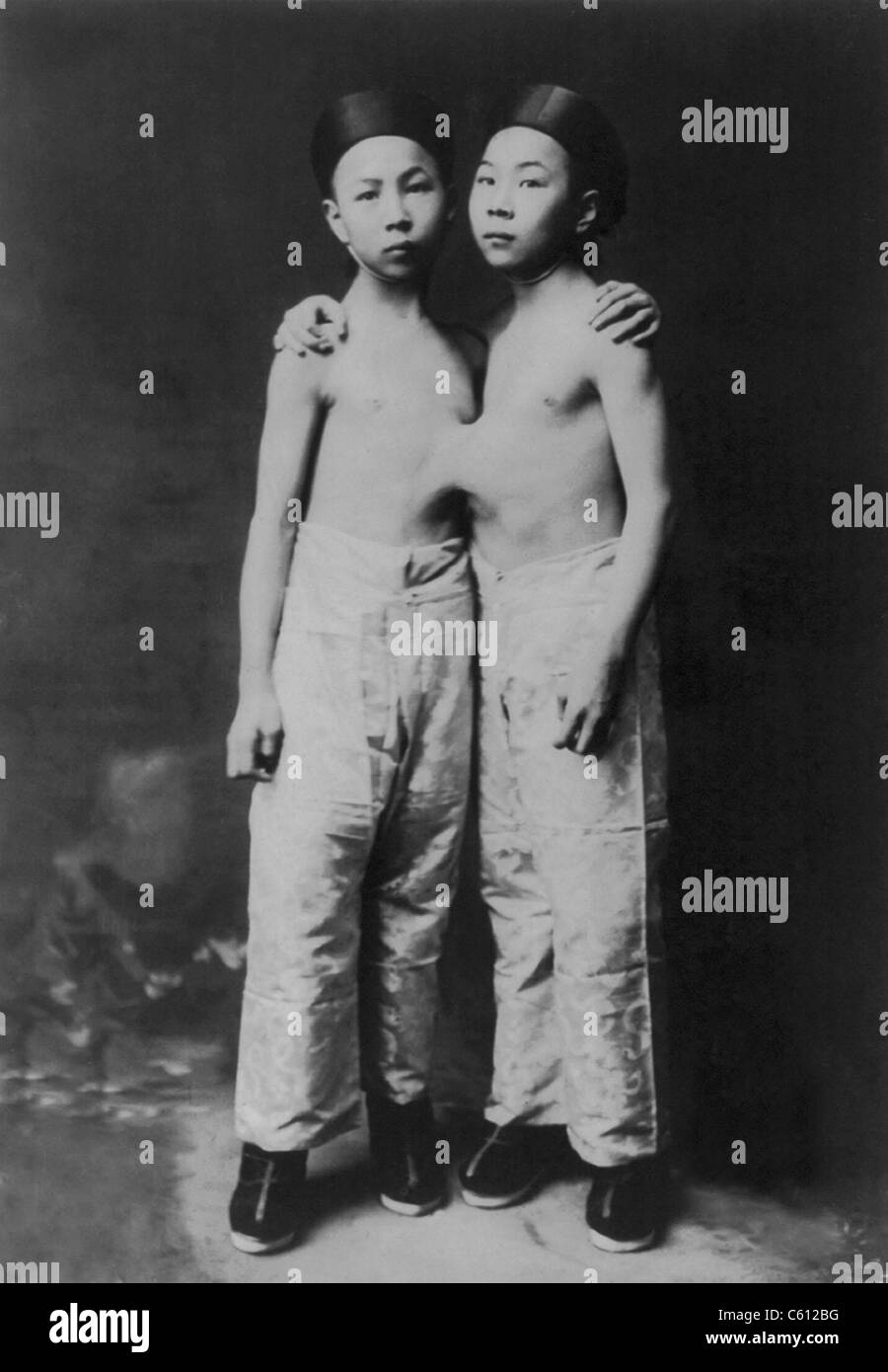 Jumeaux siamois coréen debout avec les mains sur leurs épaules. 1903. Banque D'Images