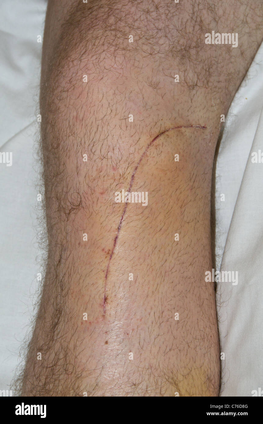 L'opération pour réparer une fracture de l'articulation du genou (voir également x-ray images de vis et goupilles de plaques) Banque D'Images