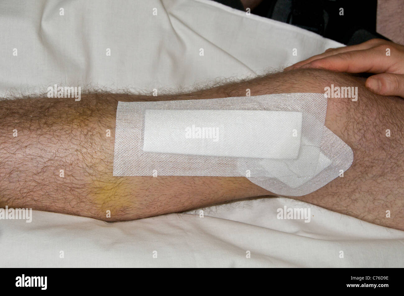 L'opération pour réparer une fracture de l'articulation du genou (voir également x-ray images de vis et goupilles de plaques) Banque D'Images