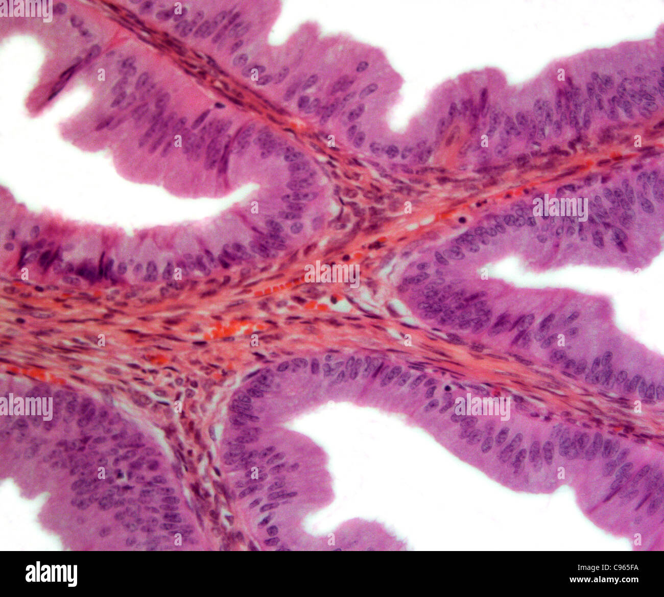 Polype Nasal Banque D Image Et Photos Alamy