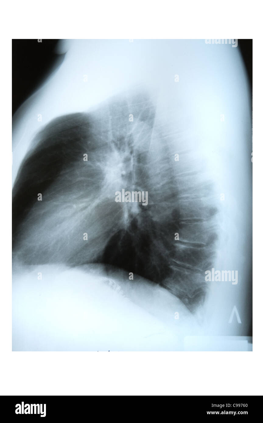 Objet sur blanc - X-ray image d'estomac Banque D'Images