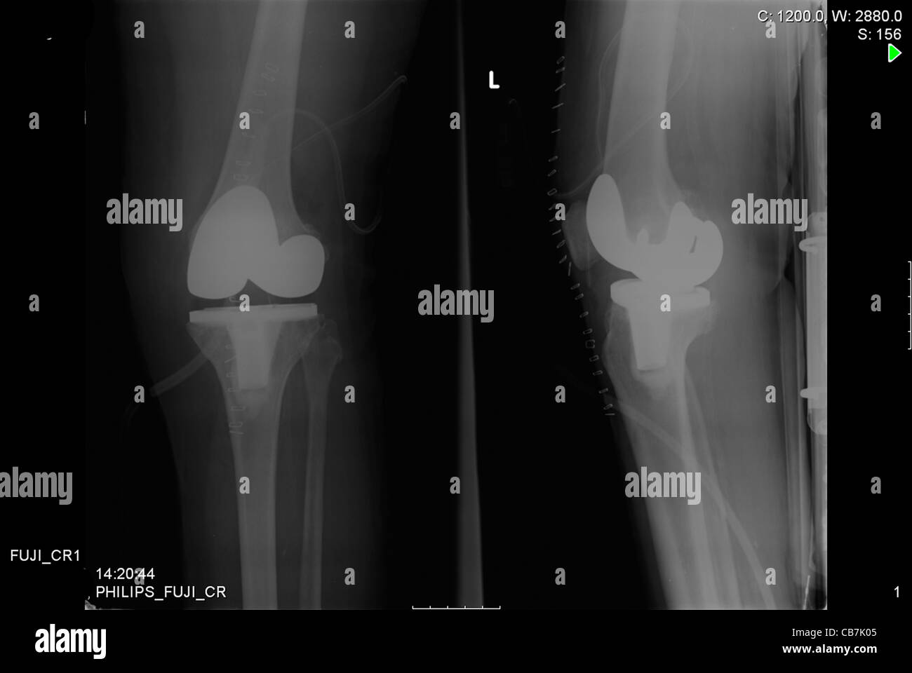 Radiographie d'un patient âgé de 74 ans avec Prim'osthéo dans la partie inférieure de la jambe et du genou Banque D'Images