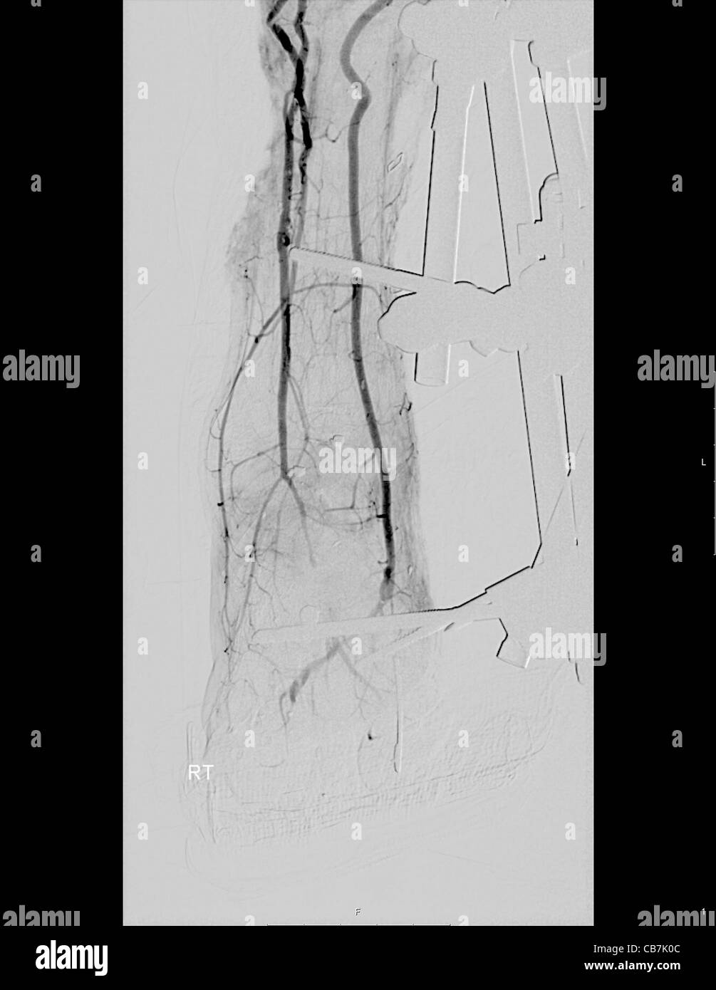X-ray du tibia et du péroné d'un homme de 23 ans patient. Metal corrections ont été insérés pour réparer une fracture des os. Banque D'Images