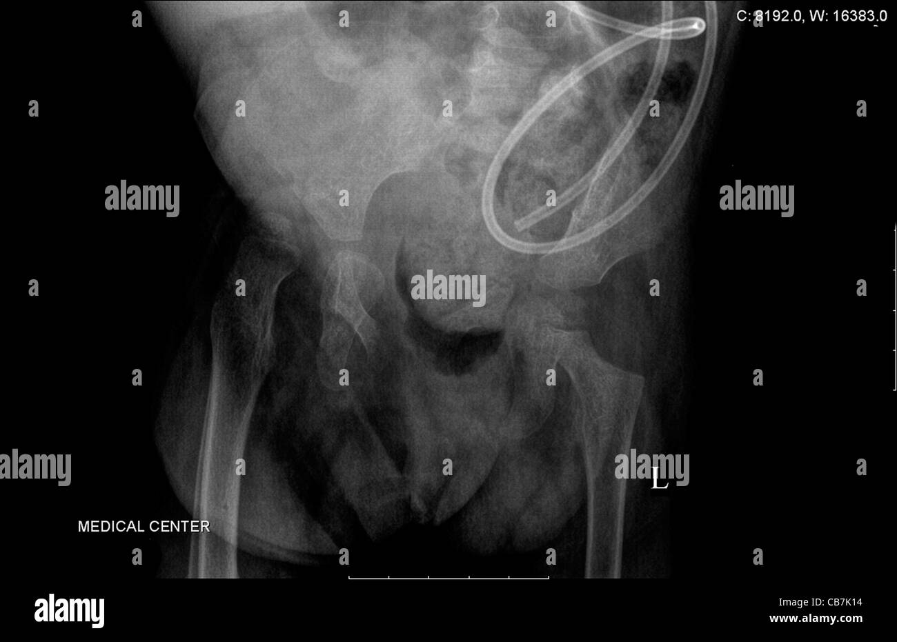 Radiographie d'un enfant de 3 ans avec un talon fracture du tibia et du péroné Banque D'Images