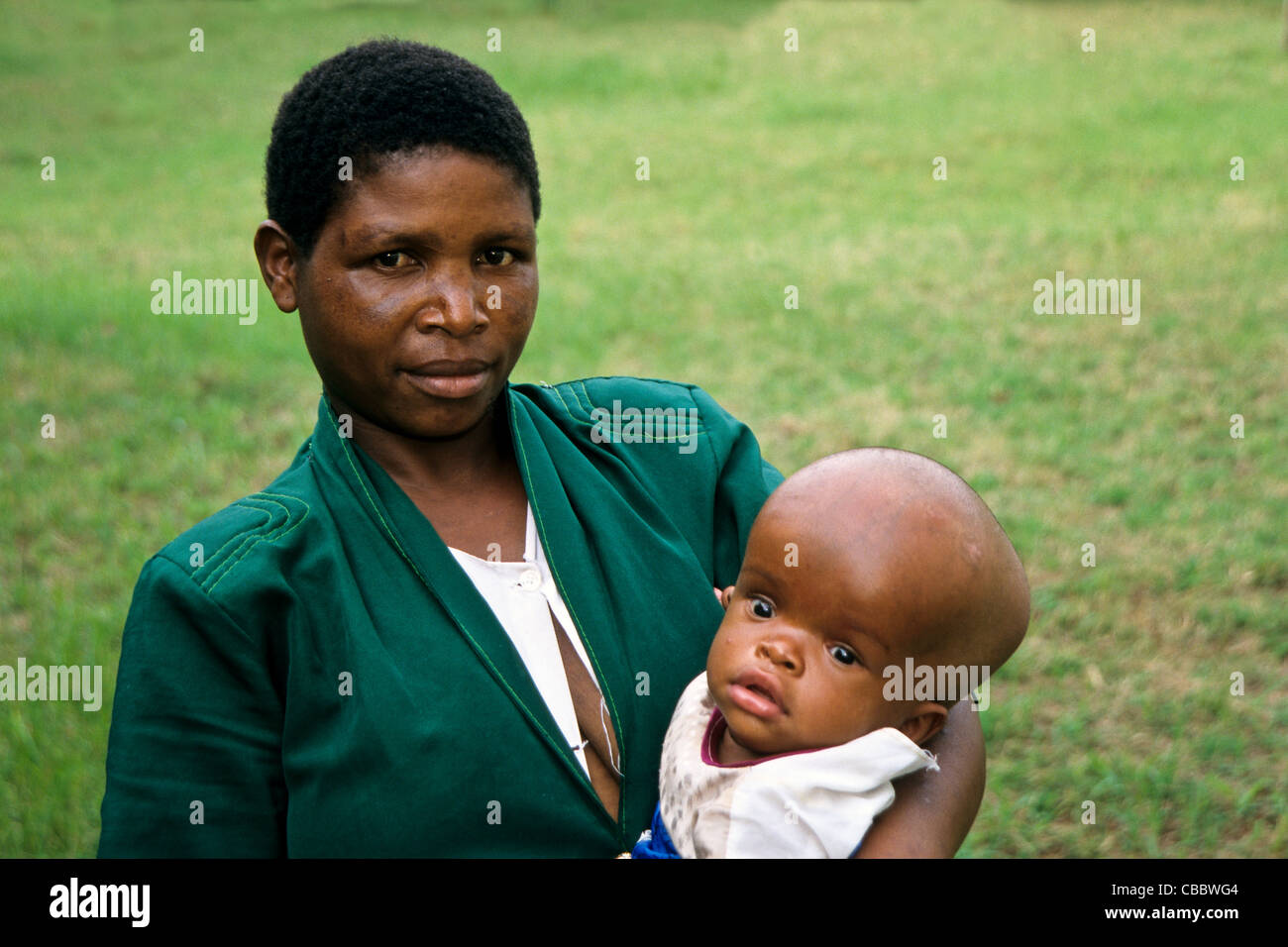 Mère portant son enfant d'hydrocéphalie, Moshi, Tanzanie Banque D'Images
