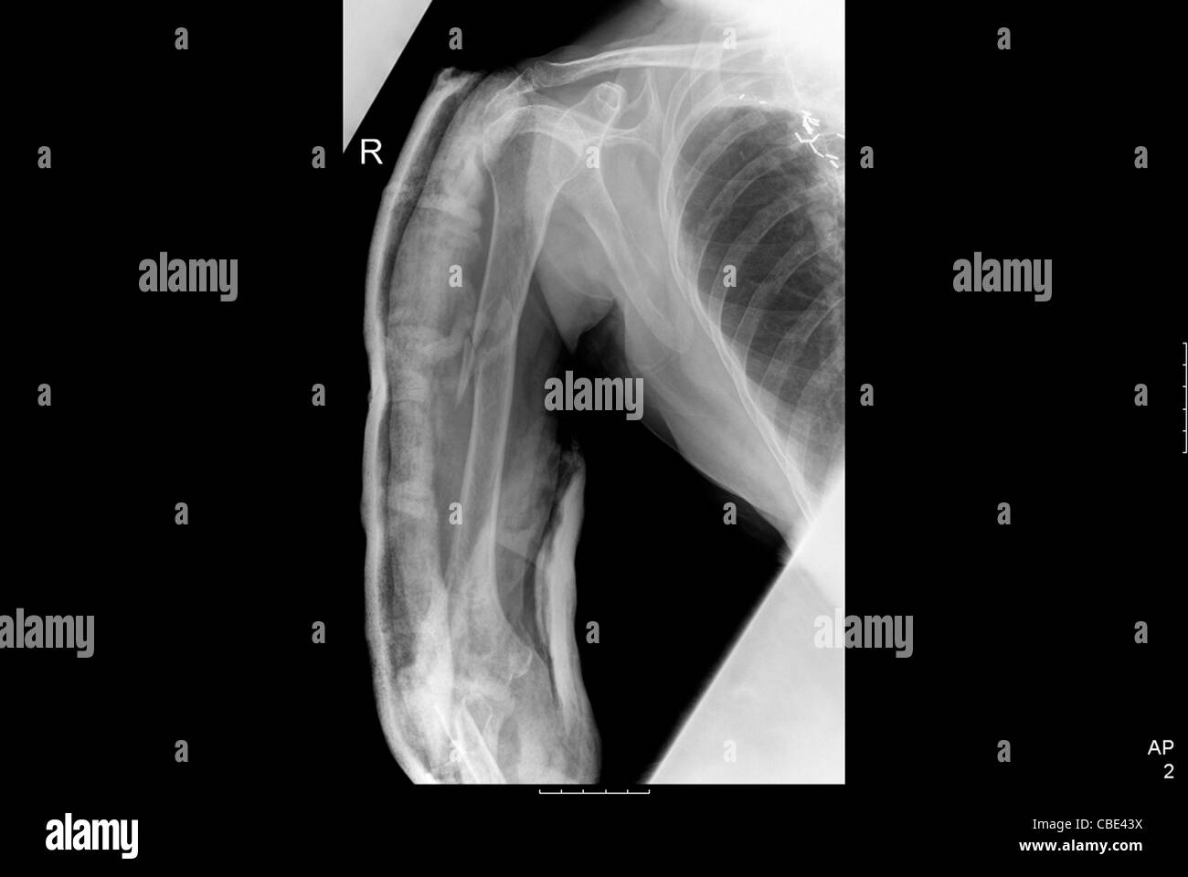 Bras et épaule radiographie d'une patiente âgée de 80 ans avec une fracture de l'humérus Banque D'Images