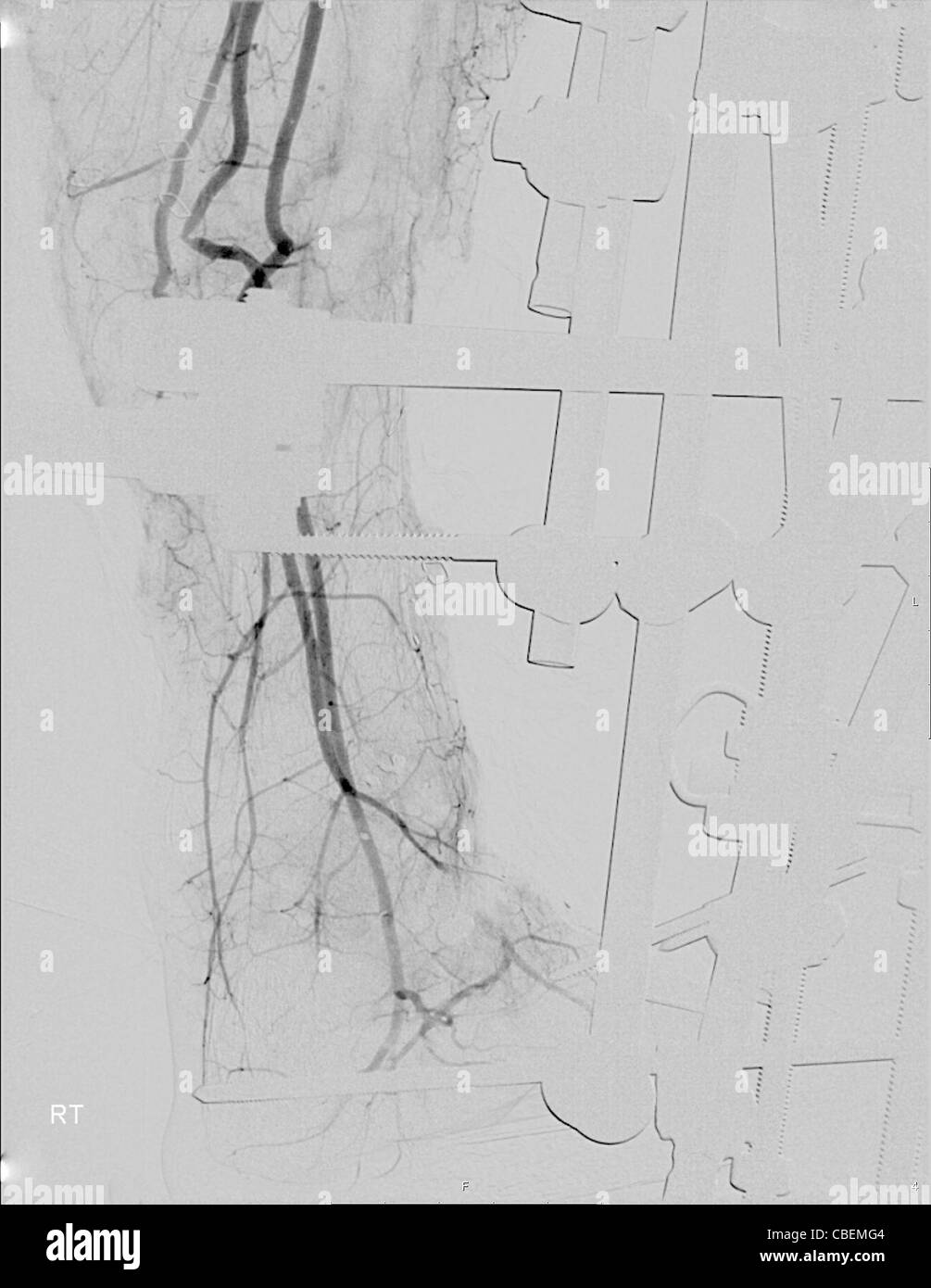 X-ray du tibia et du péroné d'un homme de 23 ans patient. Metal corrections ont été insérés pour réparer une fracture des os. Banque D'Images