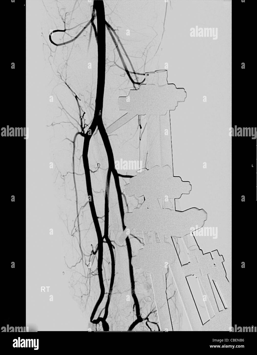X-ray du tibia et du péroné d'un homme de 23 ans patient. Metal corrections ont été insérés pour réparer une fracture des os. Banque D'Images