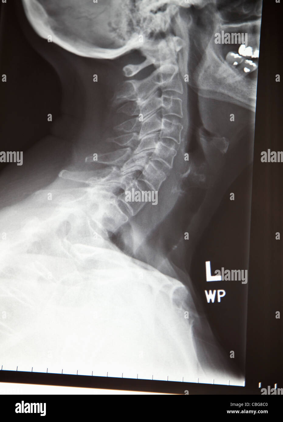 Close-up d'une radiographie d'un cou humain Banque D'Images