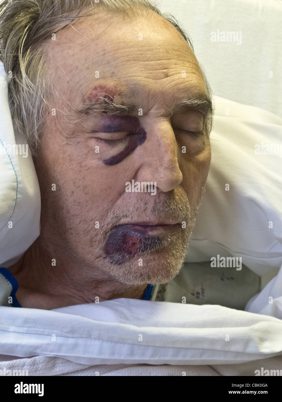 L'hôpital avec des patients de sexe masculin et de contusions oeil noir Banque D'Images