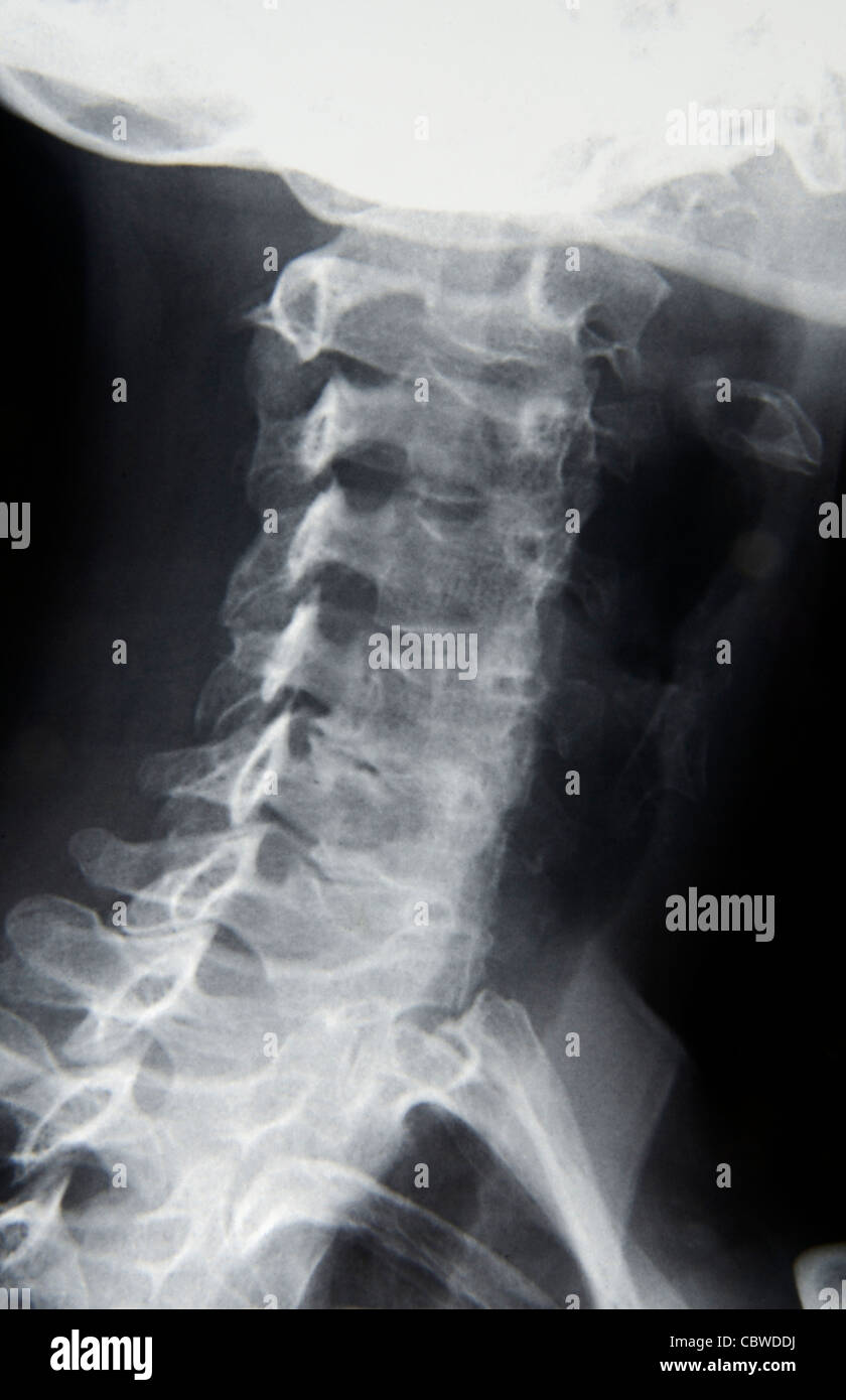 X ray image, femme squelette. Banque D'Images