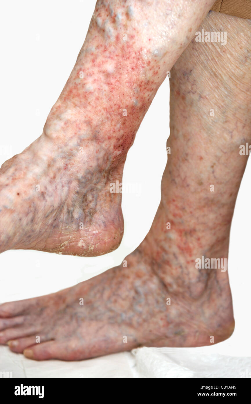 Les jambes de femme âgée souffrant d'eczéma et varices sur un fond blanc Banque D'Images