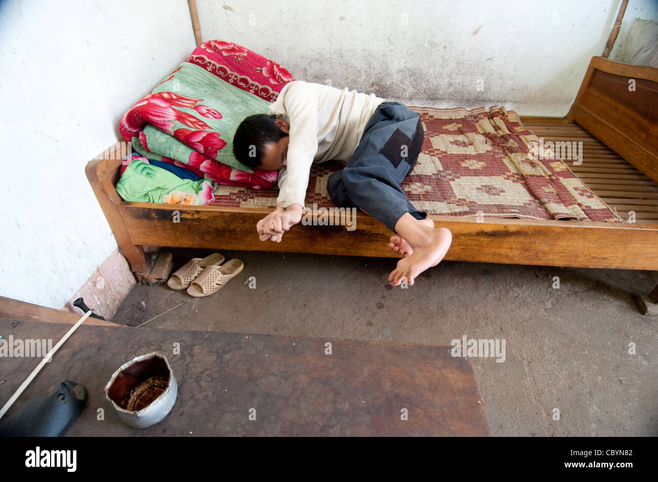 Garçon handicapé de l'adolescent, au Vietnam. Le manque d'oxygène pendant l'accouchement, souvent de graves anomalies. Banque D'Images