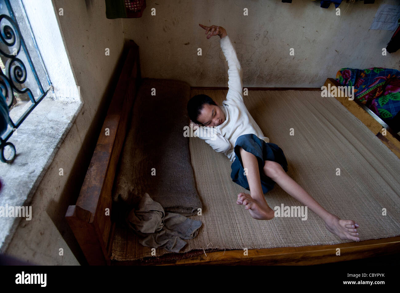 La paralysie cérébrale (CP), patient adolescent, sur un lit dans la chambre du Vietnam. Banque D'Images