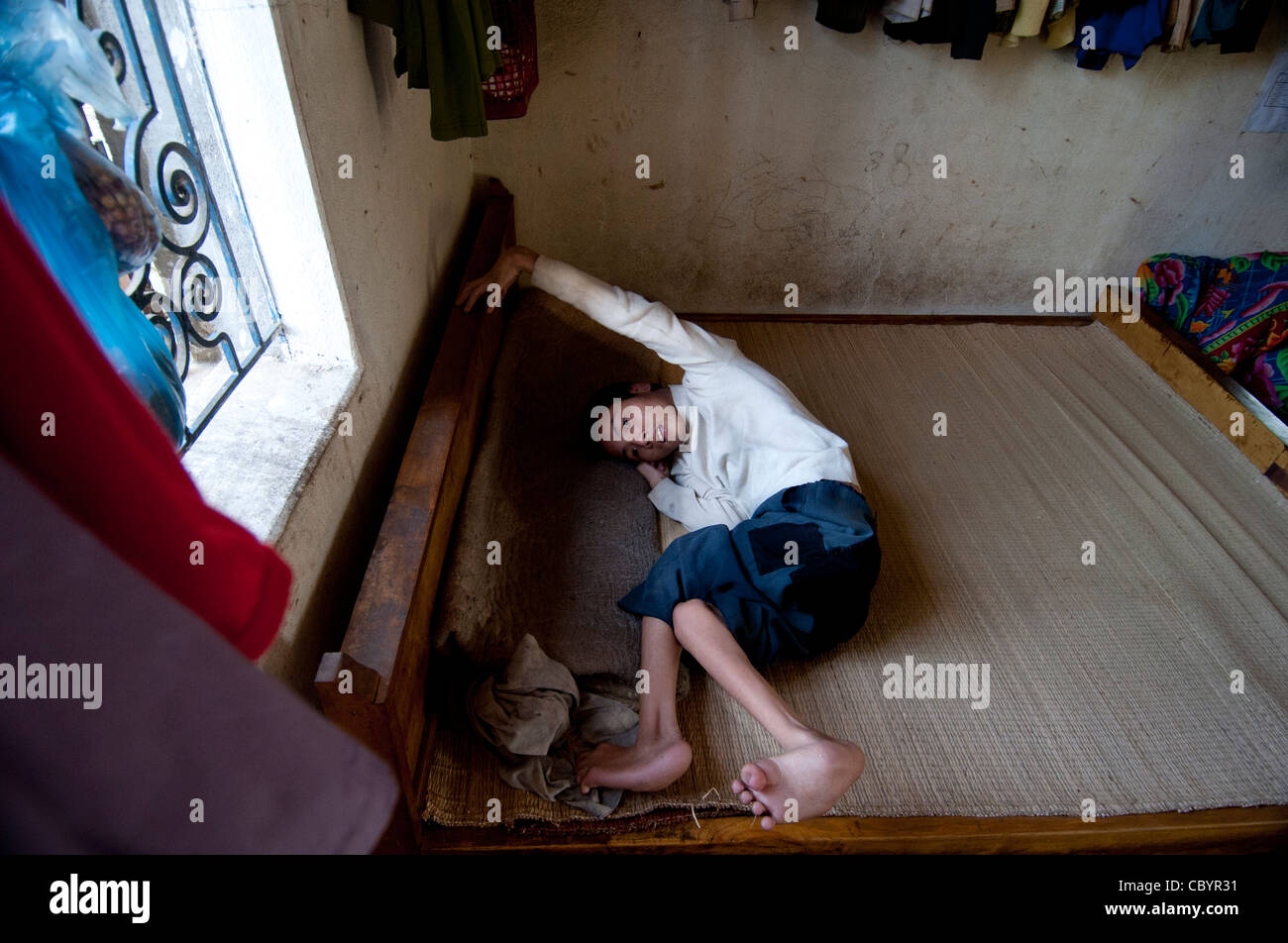 La paralysie cérébrale (CP), patient adolescent, sur un lit dans la chambre du Vietnam. Banque D'Images