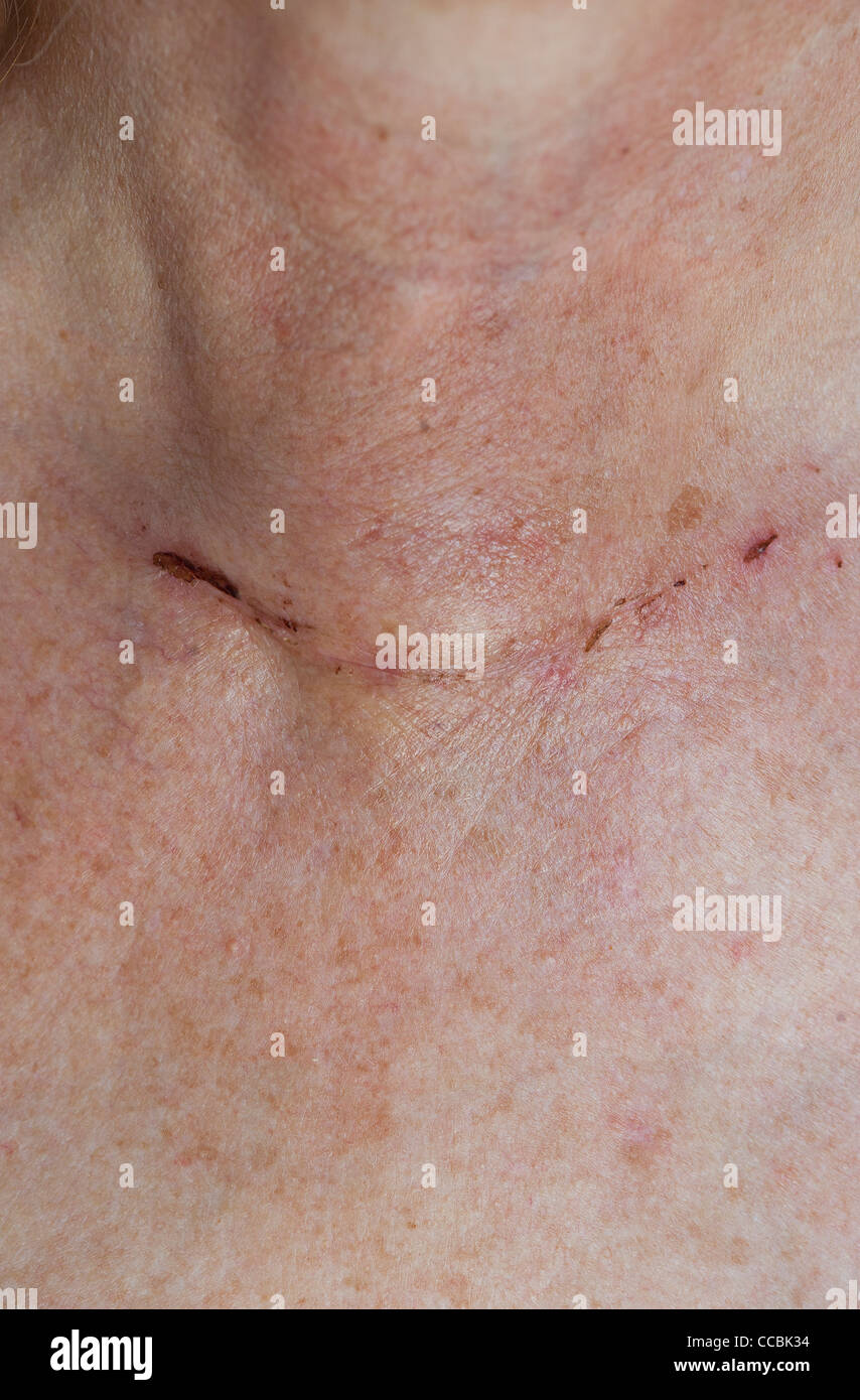 Cicatrice de thyroïdectomie Banque de photographies et d’images à haute résolution Alamy