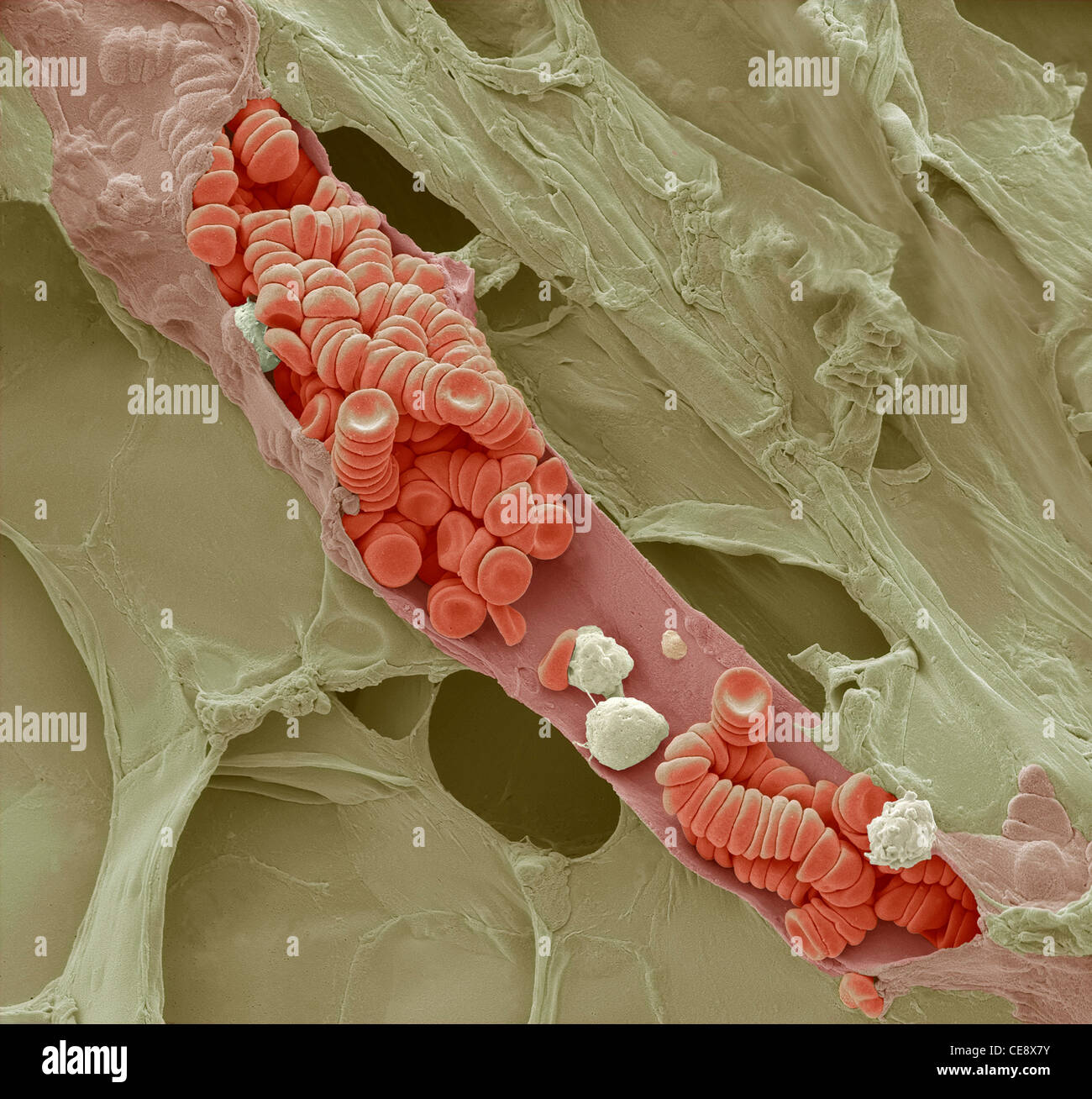 Rupture d'un venule Couleur de l'analyse des électrons Microphotographie SEM venule rupture dans les tissus gras des globules rouges empilés Banque D'Images