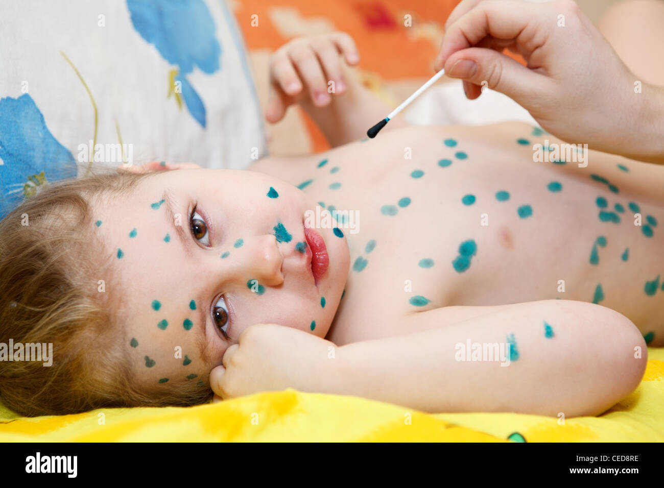 Petit enfant avec le virus varicelle-zona Maladie. Therapy de peinture verte ou vert brillant. Peuple russe Banque D'Images