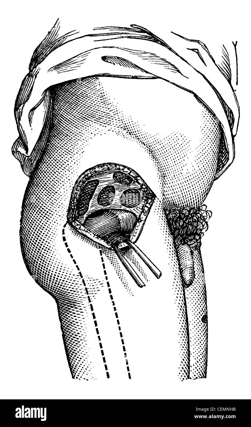 La hanche ouverte par l'extérieur, pour montrer le col du fémur, vintage engraved illustration. Magasin Pittoresque 1875. Banque D'Images