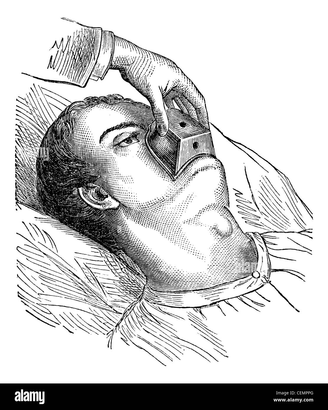 Application d'un cône de chloroforme, vintage engraved illustration. Magasin Pittoresque 1875. Banque D'Images