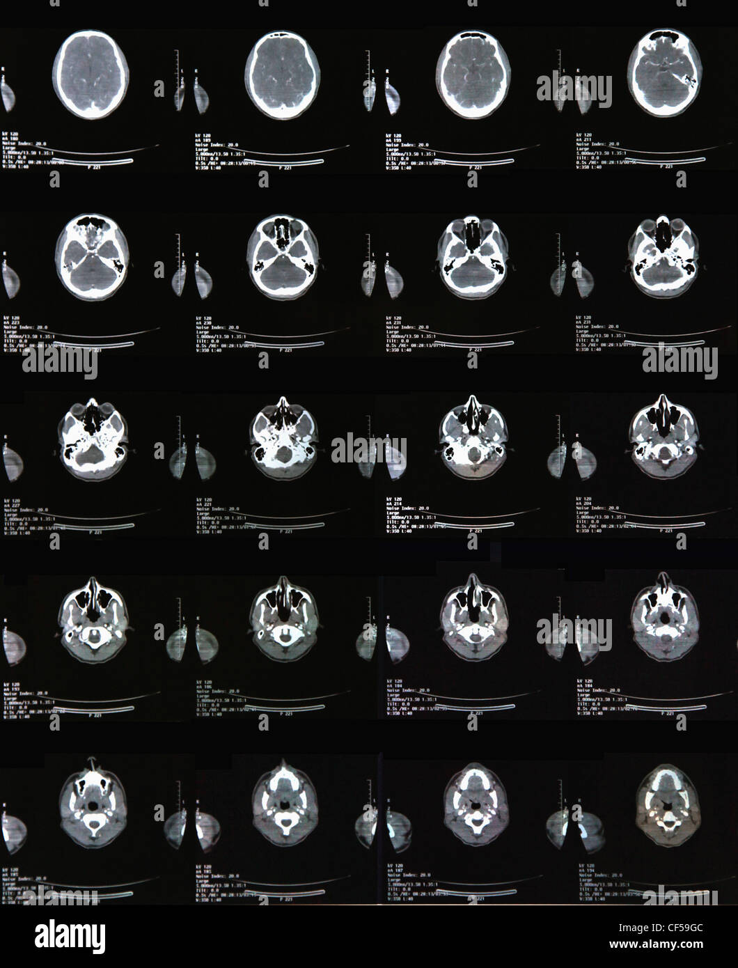 Rapport du ct scan crâne tête, Close up Banque D'Images