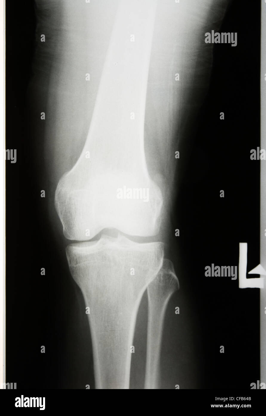 Radiographié la jambe et du genou Banque D'Images