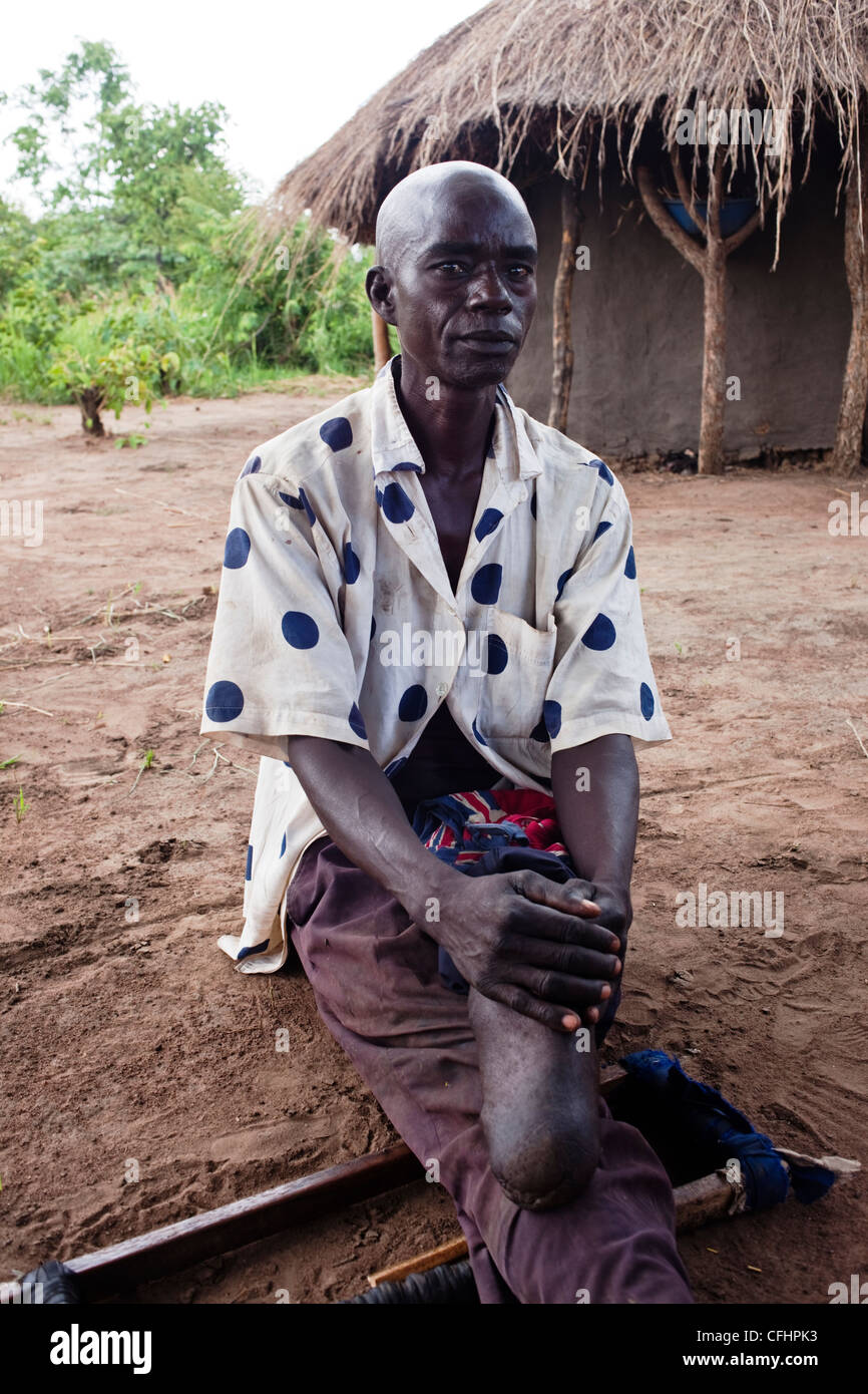 Ancien soldat avec la LRA qui a perdu une jambe à la guerre dans le nord de l'Ouganda Banque D'Images