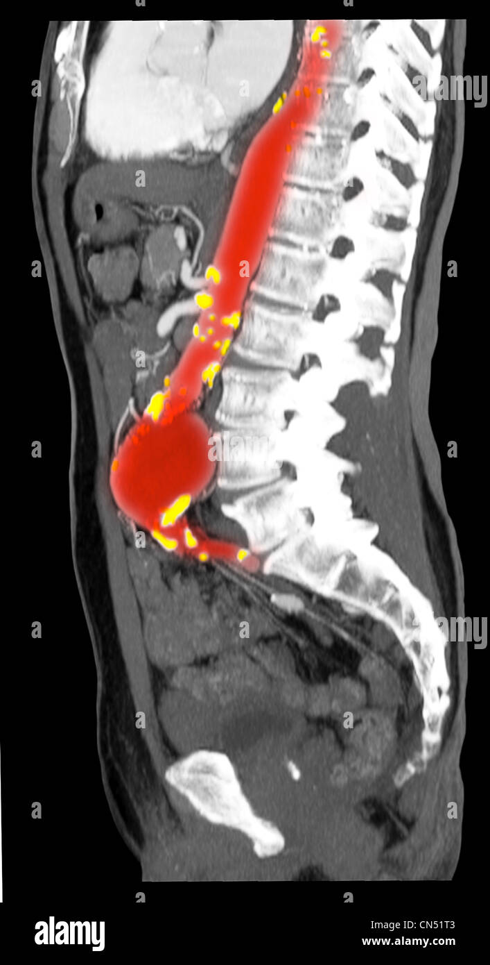 Abdominal aorta aneurysm Banque de photographies et d’images à haute