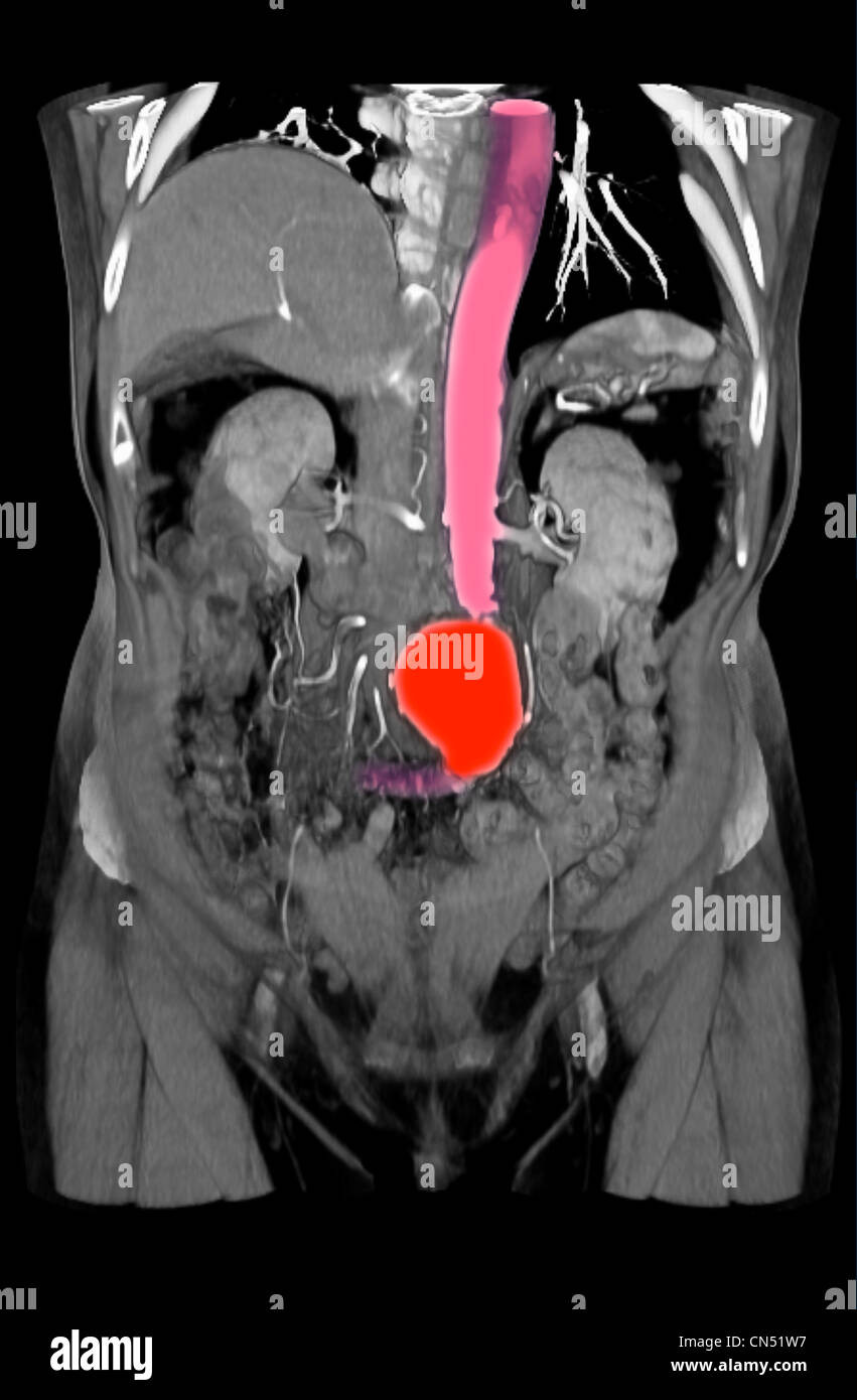 ct-scanner-des-images-montrant-un-an-vrisme-de-l-aorte-abdominale-photo
