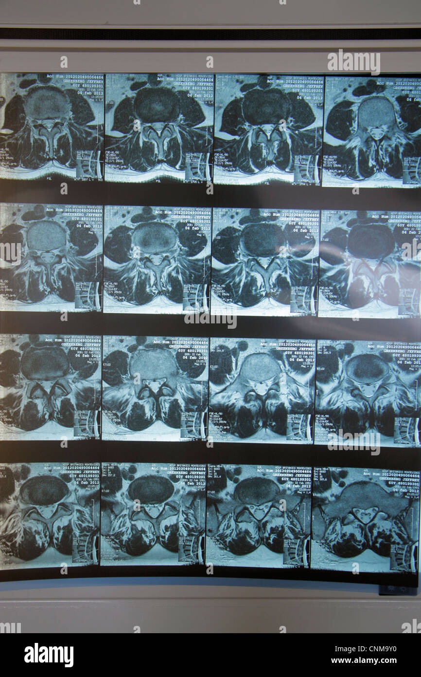 Miami Beach Florida, Mount Mt. Sinai Medical Center,centre,hôpital,santé,rayons X,rayons X,mâle,colonne vertébrale,bassin,coupe transversale,disque rompu L4 L5, Banque D'Images