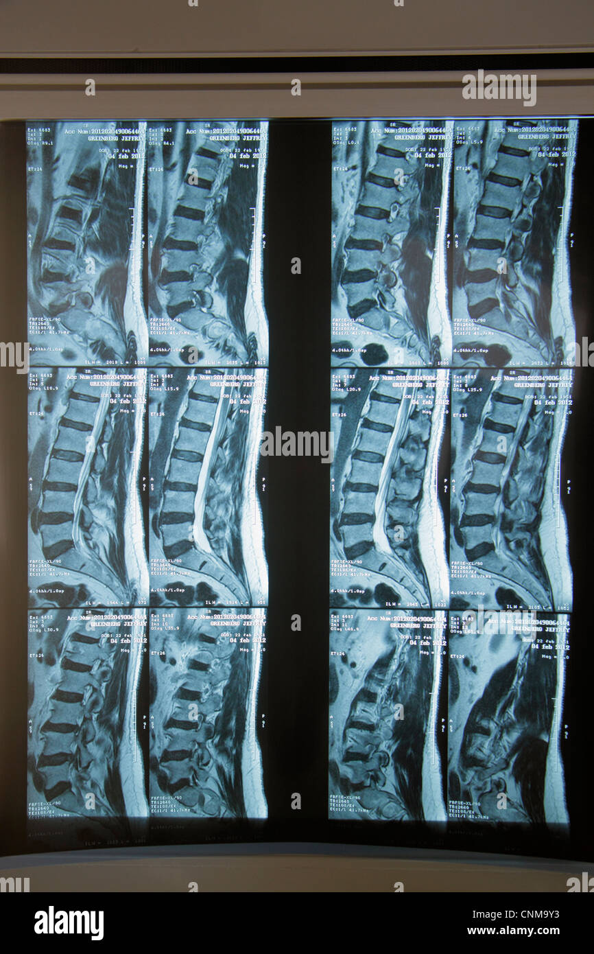 Miami Beach Florida, Mount Mt. Sinai Medical Center,centre,hôpital,santé,rayons X,rayons X,mâle,colonne vertébrale,pelvis,disques,disque rompu L4 L5,FL120311 Banque D'Images
