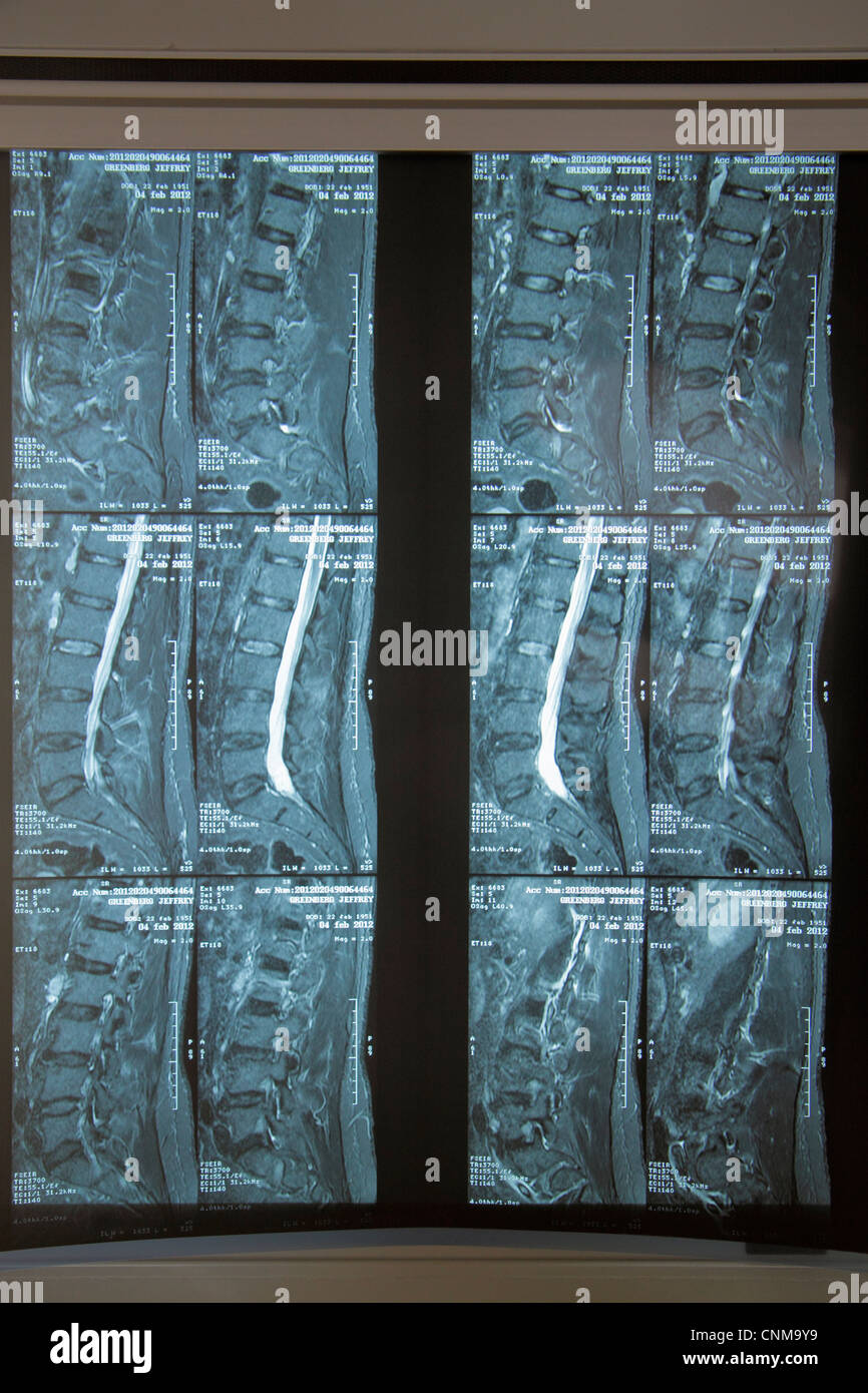 Miami Beach Florida, Mount Mt. Sinai Medical Center,centre,hôpital,santé,rayons X,rayons X,mâle,colonne vertébrale,pelvis,disques,disque rompu L4 L5,visiteurs Banque D'Images