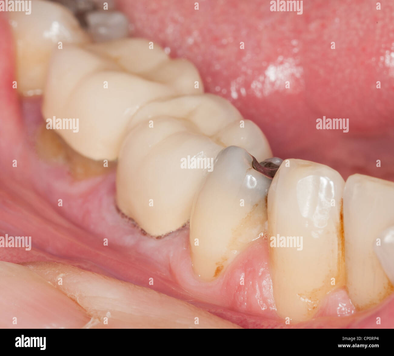 Macro Close up shot de l'intérieur de la bouche et les obturations et les couronnes sur les dents Banque D'Images