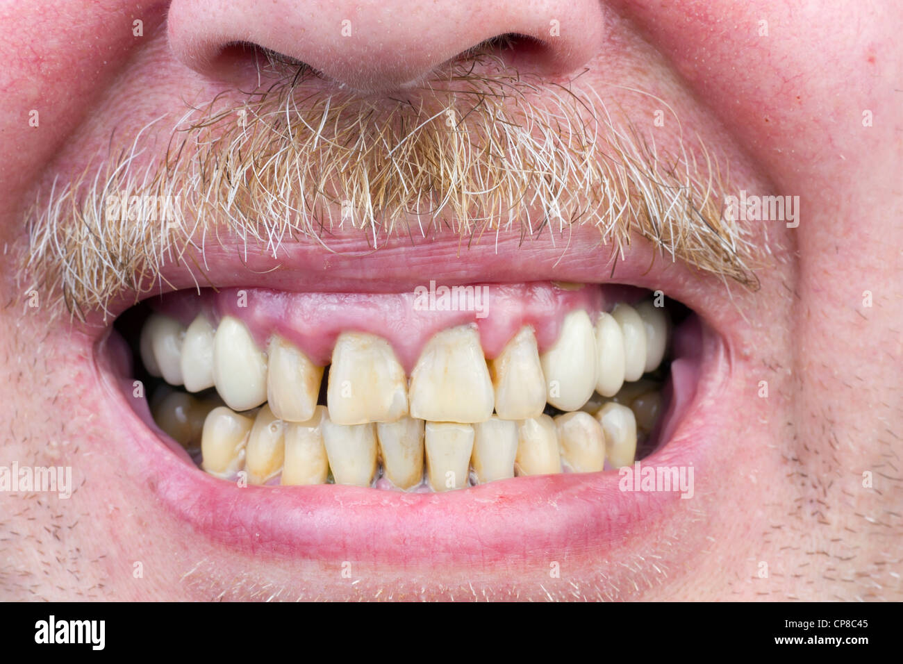 Les dents Jaunes sont malades, malades des gencives, la peau des hommes  unshaved rouge, gris moustache macro. Les méfaits de l'alcool et le tabac.  Str Photo Stock - Alamy