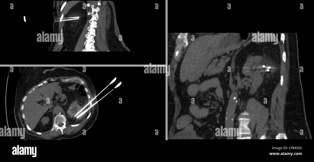 La cryothérapie, tumeur rénale Banque D'Images