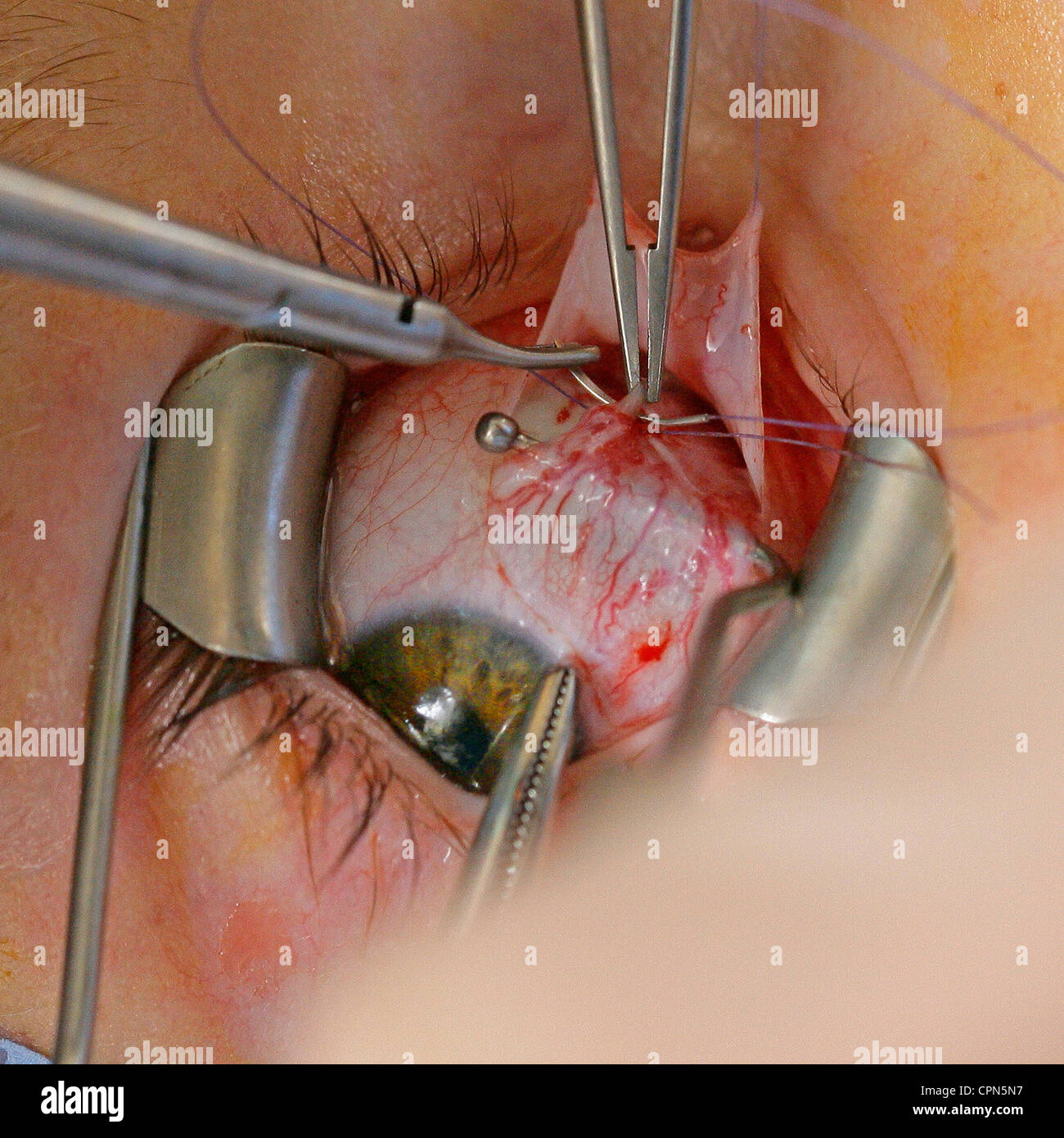 Le strabisme, chirurgie Photo Stock - Alamy