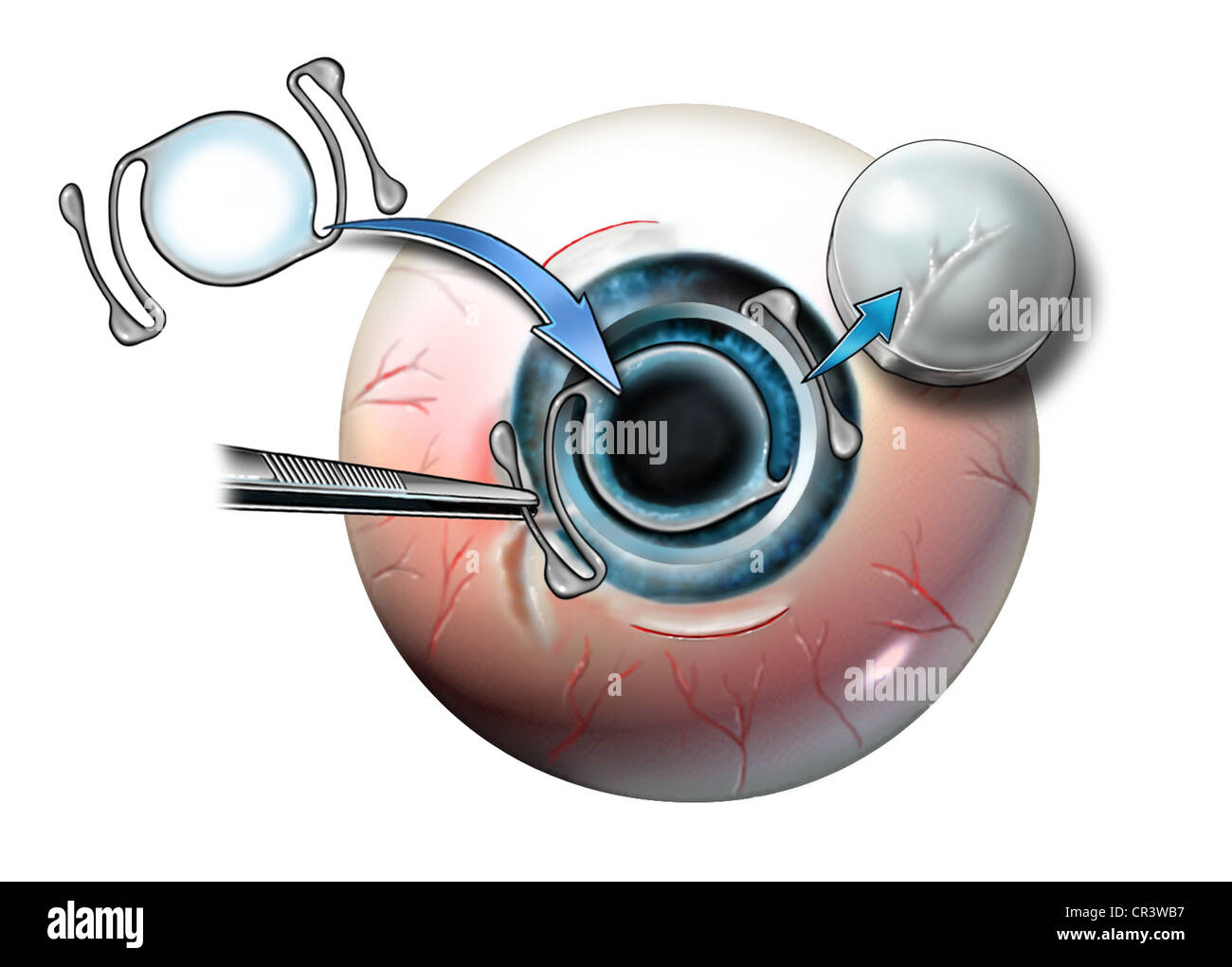 IOL lentille intraoculaire de la chambre antérieure Photo Stock - Alamy