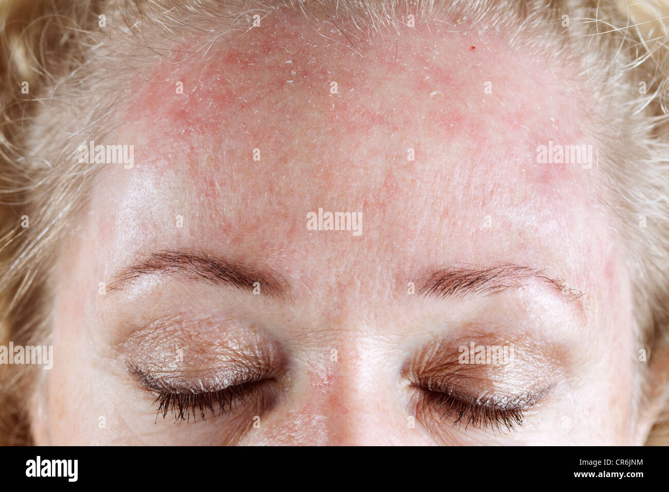 Peau Qui Pele Banque D Image Et Photos Alamy