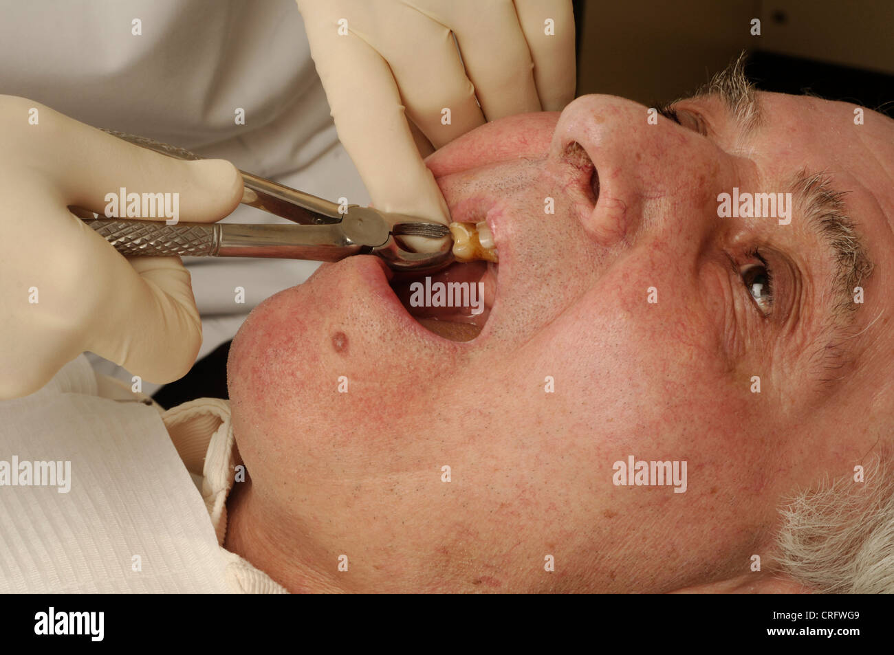 Un dentiste dépose un homme âgé a dent avec une paire de pinces chirurgicales. Banque D'Images